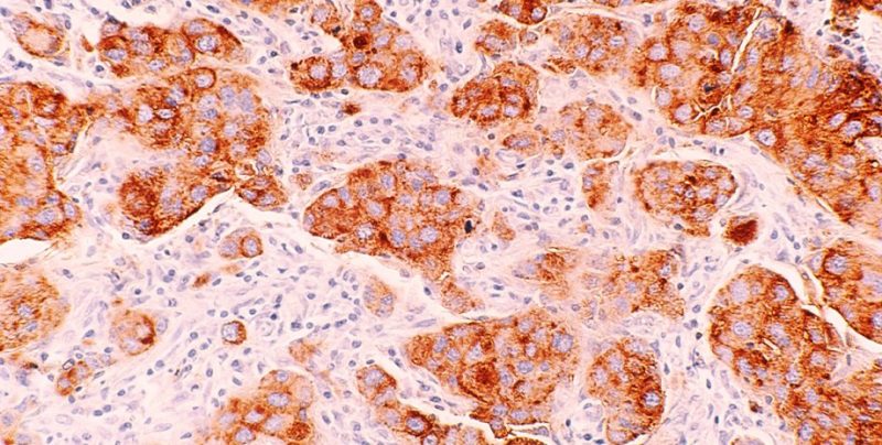 Імунотерапія відкрила шлях до безопераційного лікування раку прямої кишки