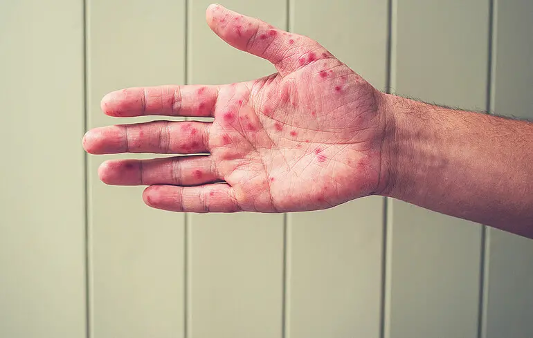 Нові спалахи кору на Закарпатті: небезпечна епідемія серед нещеплених дітей